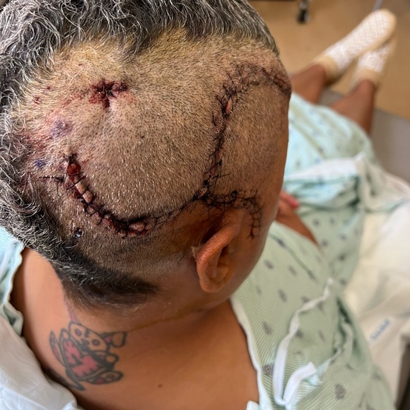 Recovering from 3rd brain surgery God is amazing! - Picture 2 of 2